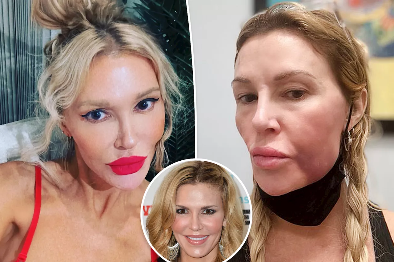 Brandi Glanville 'lost 5 teeth' while battling facial disfigurement