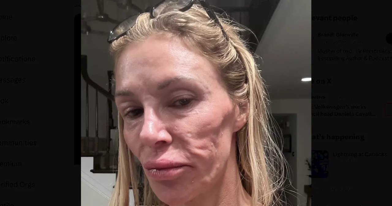 Brandi Glanville Reveals Facial Swelling Knocked Out Some of Her Teeth