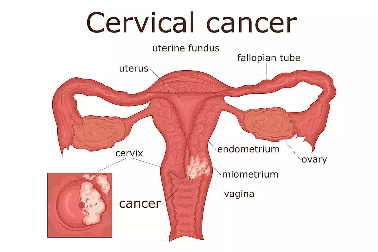 Cervical Cancer Screening Made Simple with Self-Swab Option