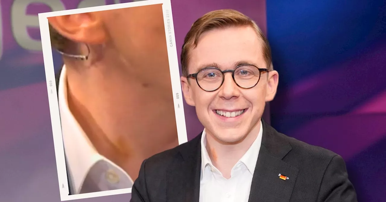 „Du Schlingel“: CDU-Politiker Philipp Amthor in ARD-Talk mit Knutschfleck erwischt