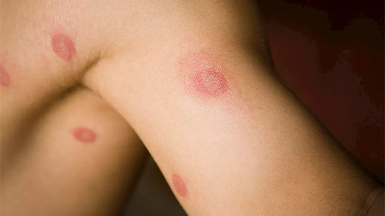 What to Know About Sexually Transmitted Ringworm