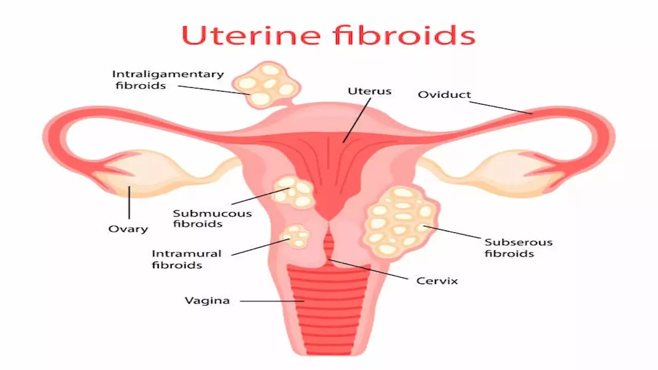 क्यों होती है फाइब्रॉयड की समस्या क्या है कारण लक्षण इलाज और इसके बचाव के उपाय