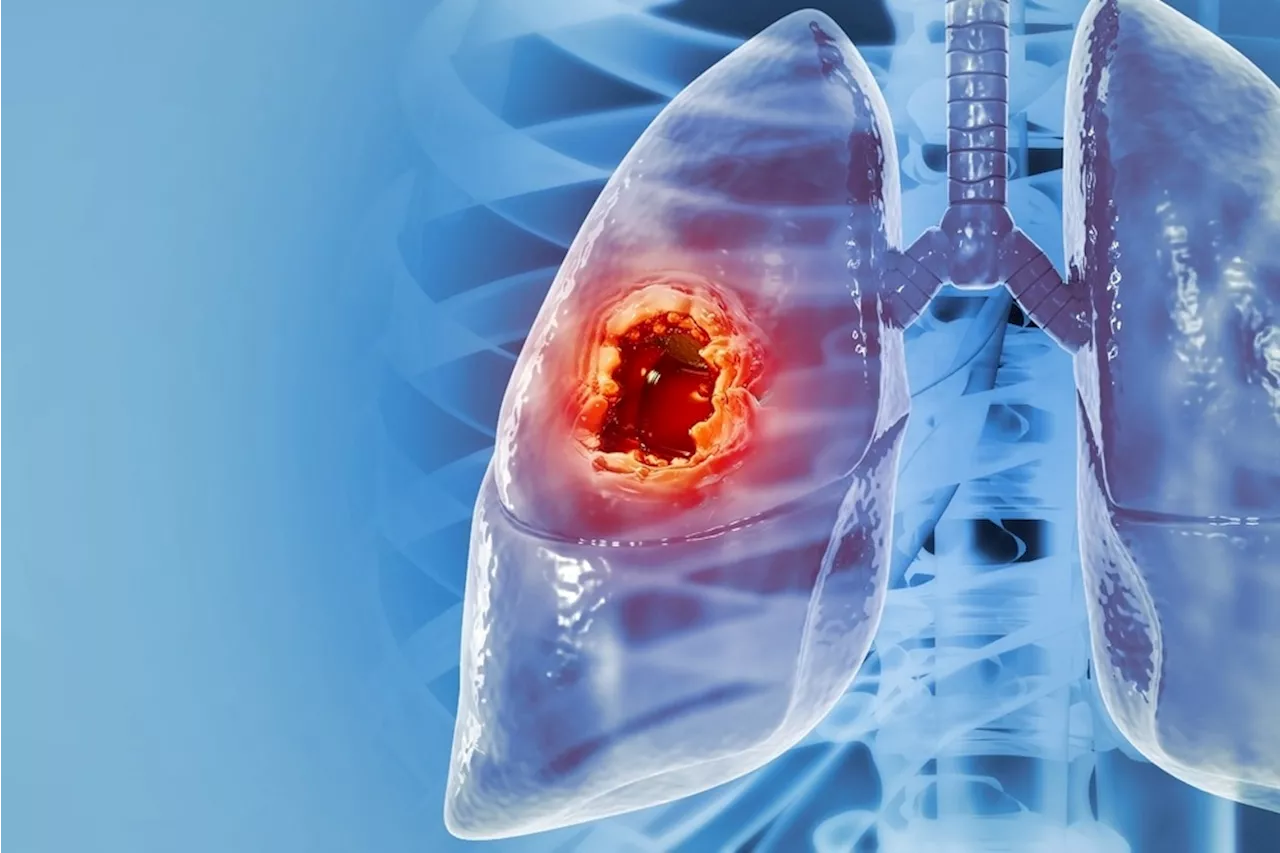 Multi-omic profiling sheds light on chemo-immunotherapy resistance in lung cancer