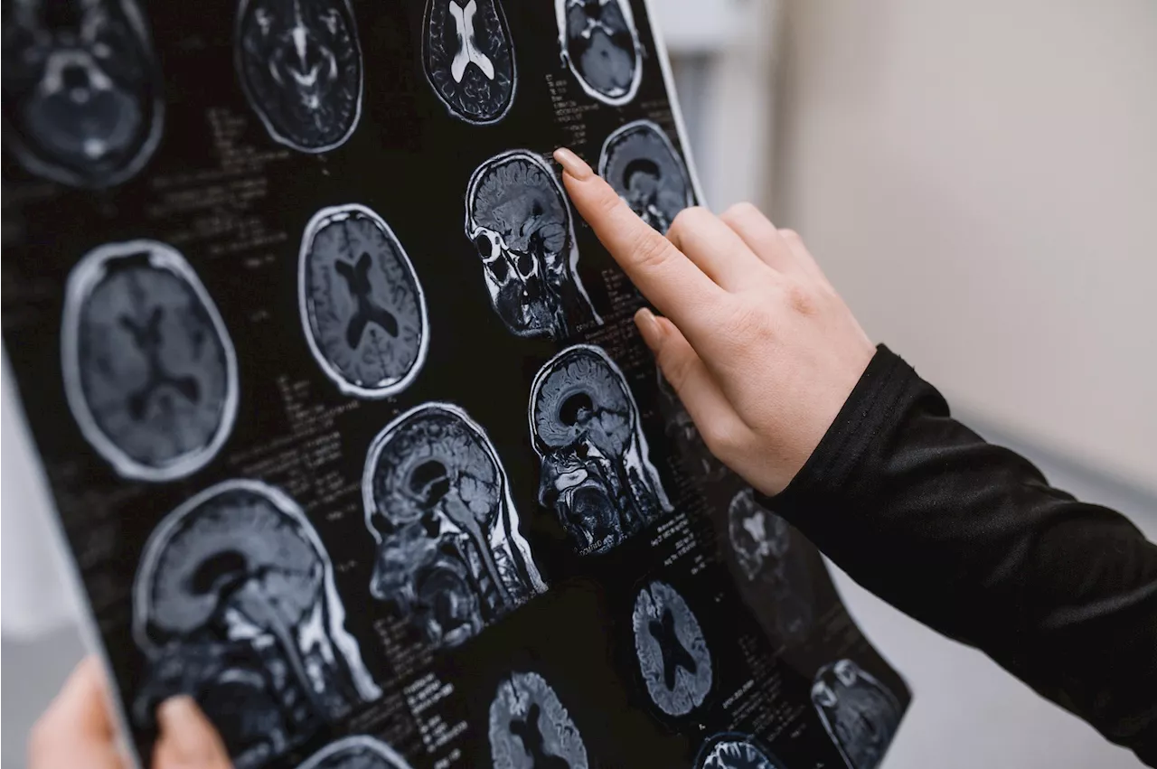 Portable MRI and AI improve Alzheimer’s diagnosis with cost-effective precision