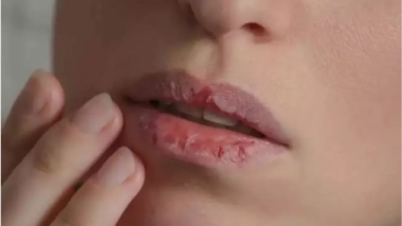 Ini Penyebab Bibir Kering Pecah-Pecah dan Tips Ampuh Mengatasinya!