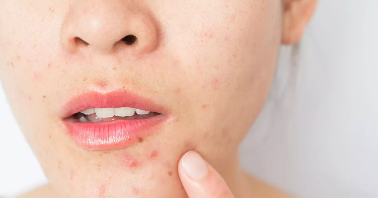 Facial Breakouts: An Unexpected Sign of Poor Gut Health