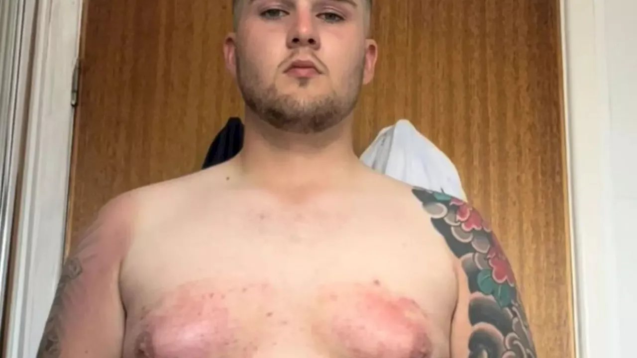 Man With 'C Cup Breasts' Undergoes Surgery to Remove Excess Tissue