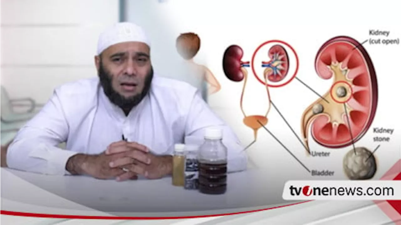 Obat Alami Hancurkan Batu Ginjal