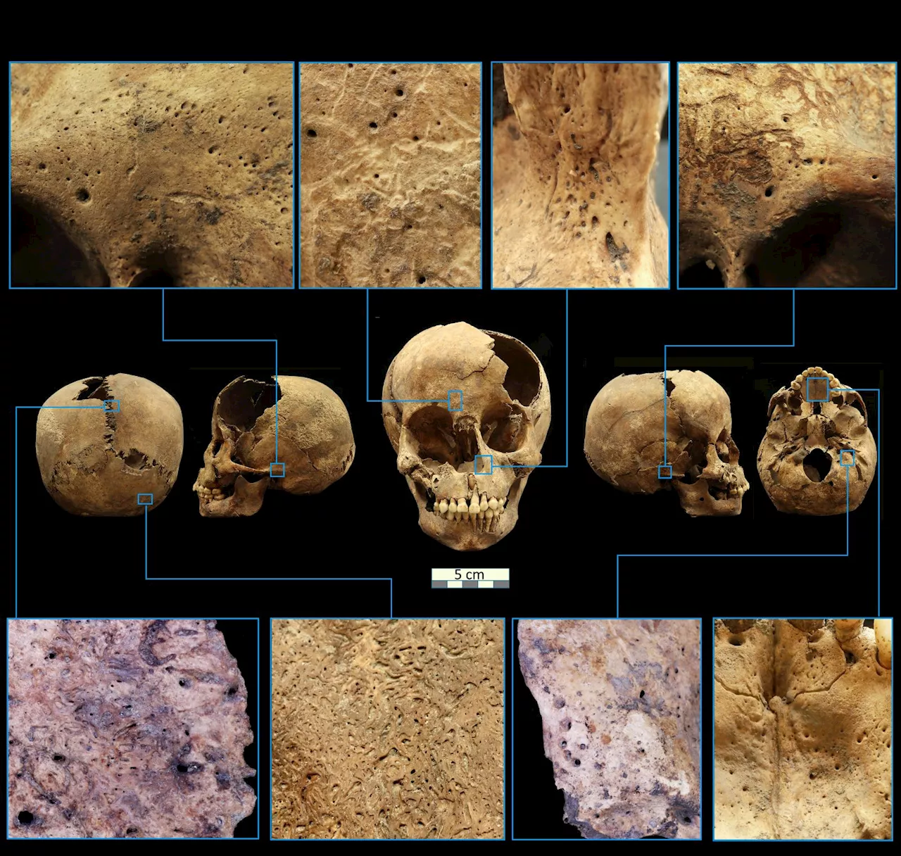 Sífilis en América Precolombina: Estudio revela diversidad de bacteria antes de la llegada de Colón