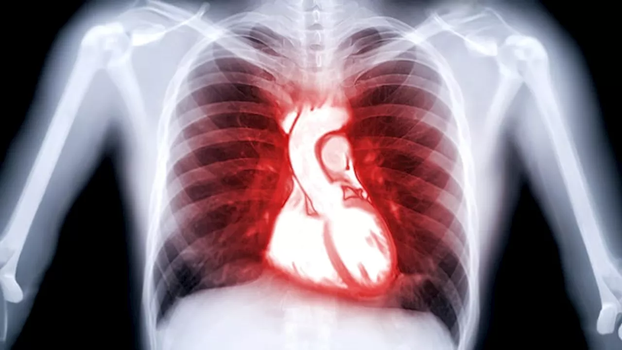 Treprostinil Aids Patients With Pulmonary Arterial Hypertension and Cardiovascular Issues