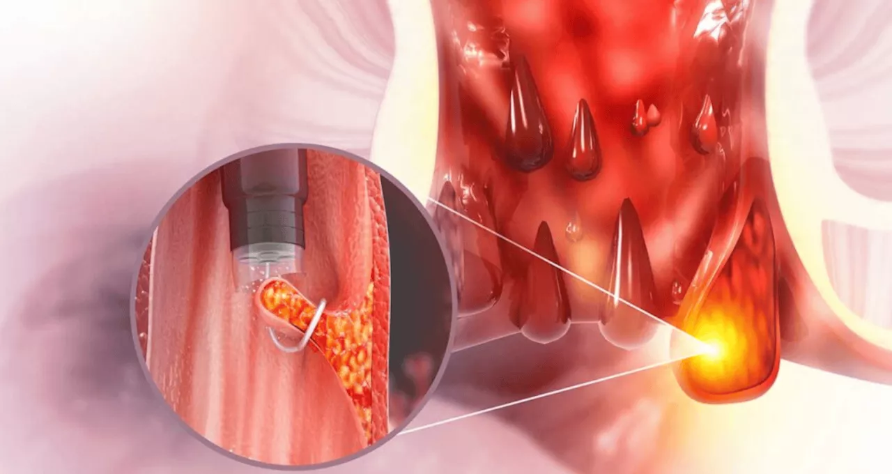 Hemorroides: un problema común que afecta a millones de personas