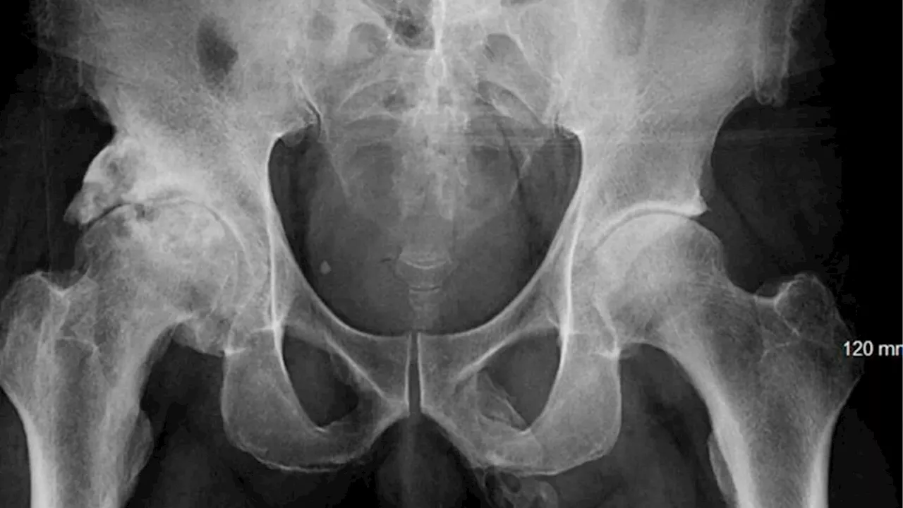 Man's Penis 'Turns to Bone' After Fall