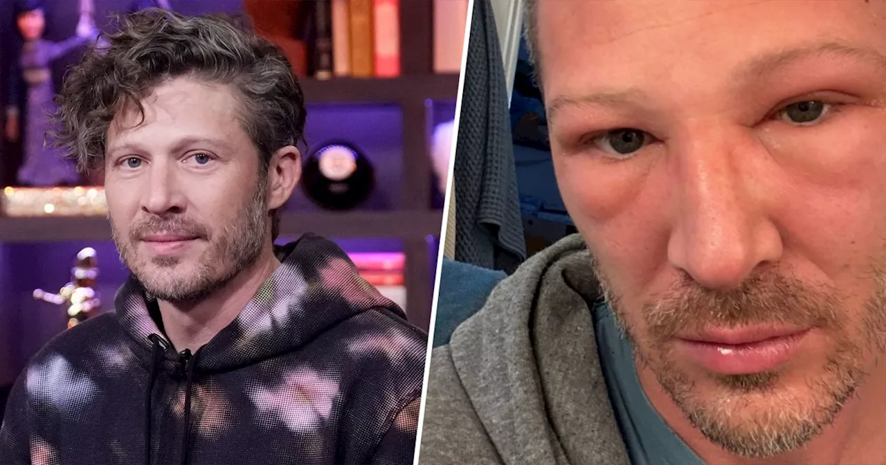 Zach Gilford Shows Swollen Face After Health Scare