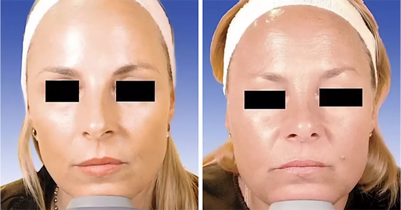 Botox Battle: Identical Twins, Divided Opinions