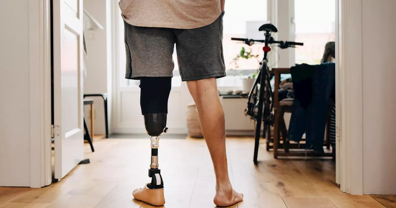 Prosthetic Leg Coverage Denied, Raising Questions of Discrimination