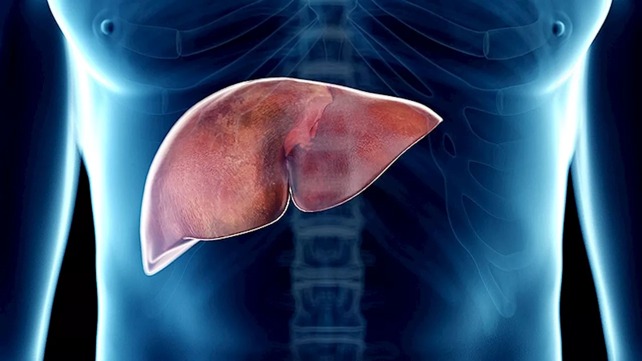 GLP-1 Receptor Agonists Show Promise in Treating Metabolic-Associated Fatty Liver Disease (MASLD)