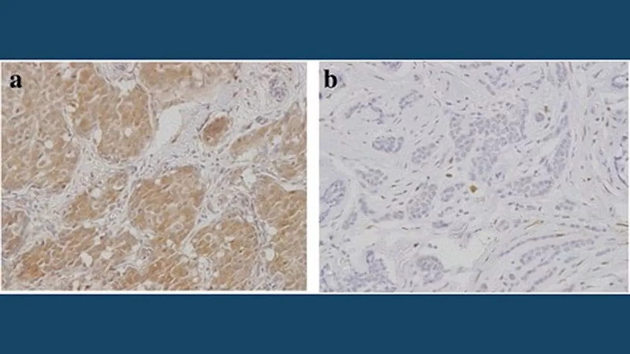 Nab-Paclitaxel Improves Survival in HR+/HER2– Early Breast Cancer Patients with Low Recurrence Scores