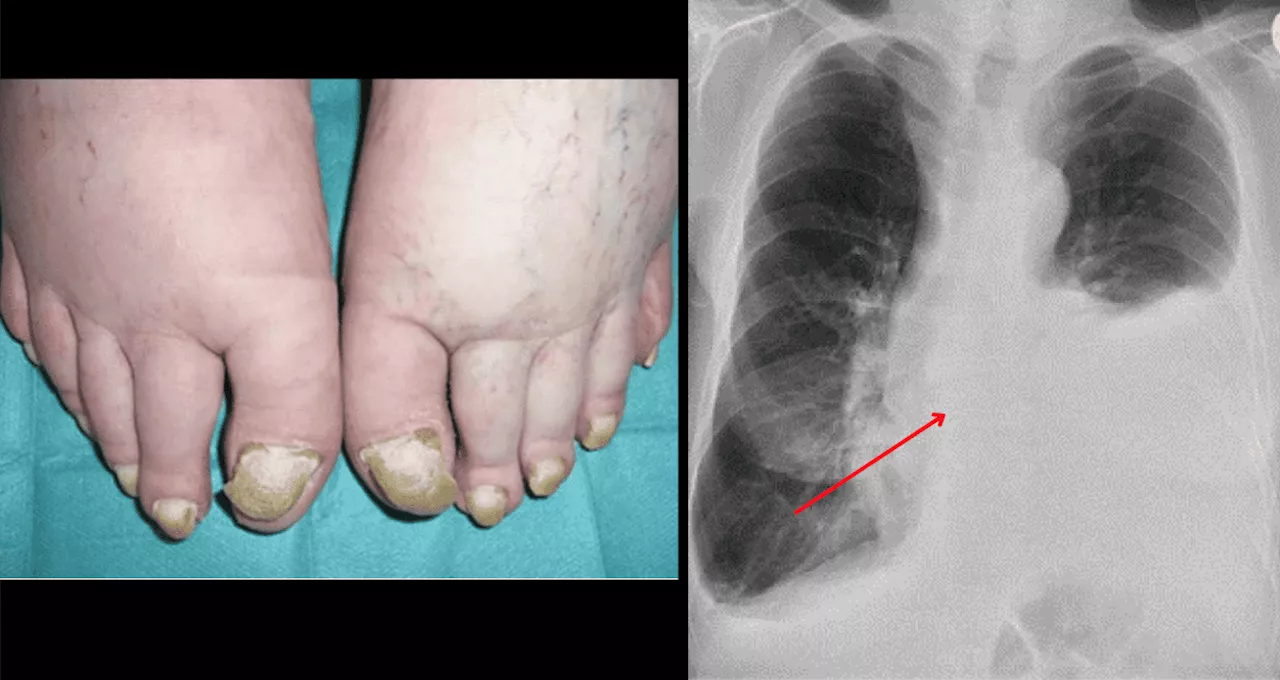 Síndrome de uña amarilla asociado al crecimiento anormal de las células de grasa entre los pulmones