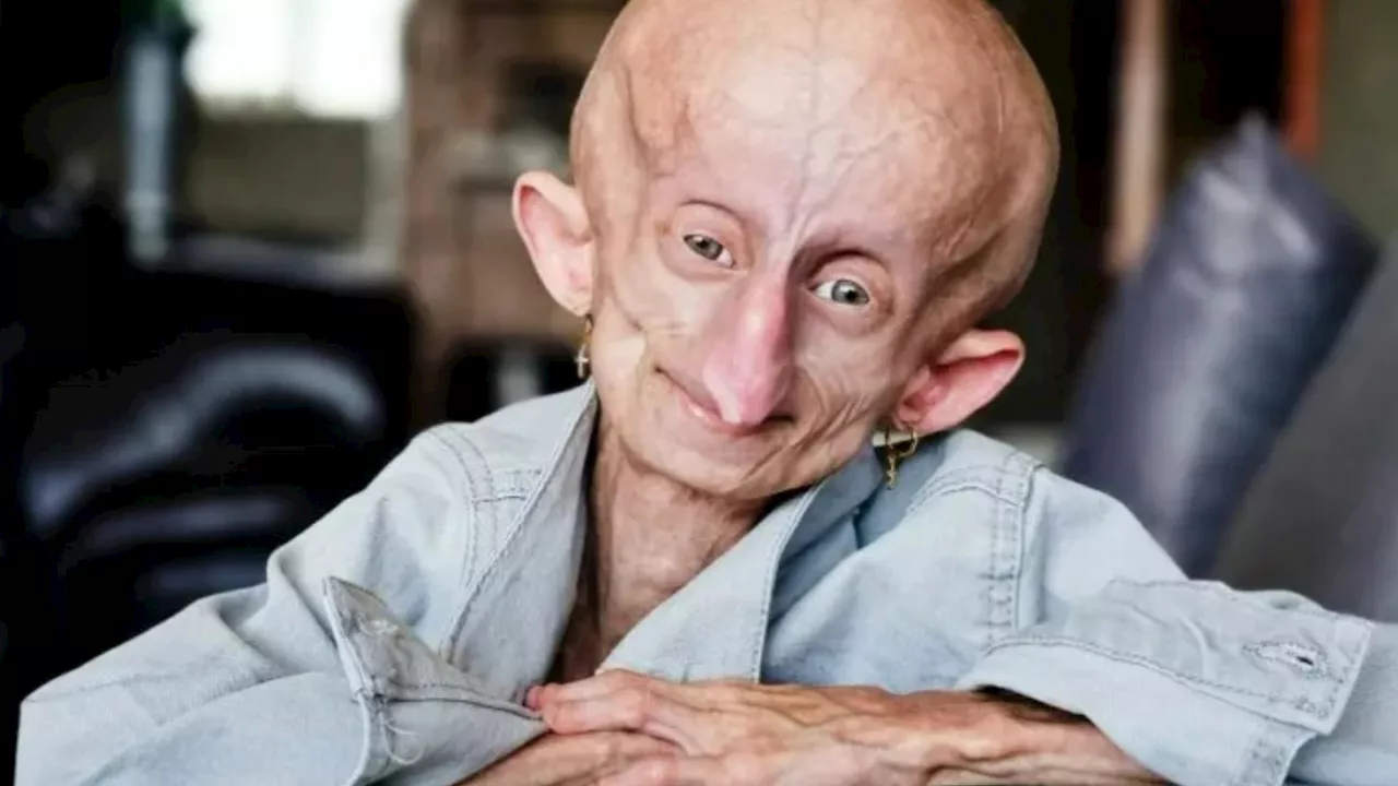 TikTok Star Beandri Booysen Dies at 19 After Battling Rare Aging Disease