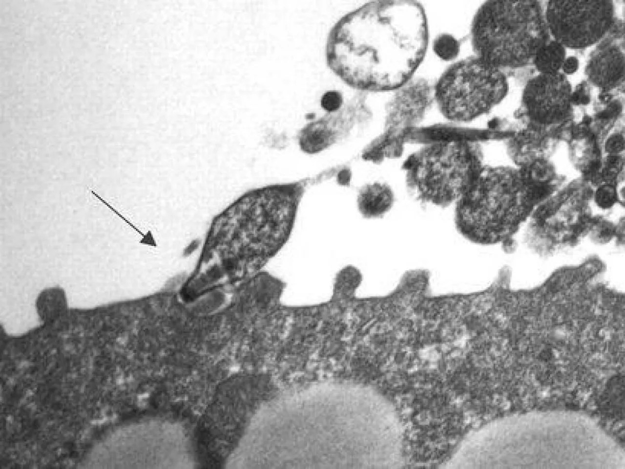 Polmonite atipica, sintomi e segnali diversi: come riconoscerli e perché cambiano le terapie