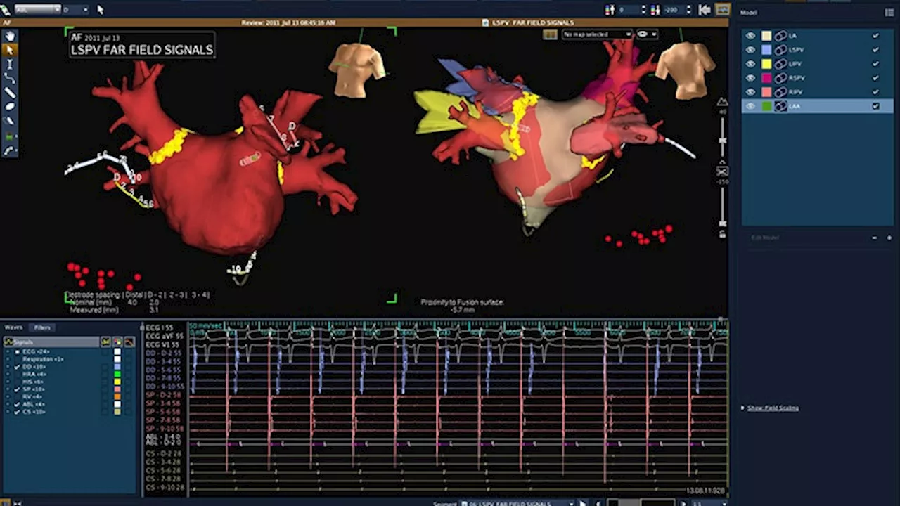 Catheter AF Ablation Growing in Popularity and Complexity