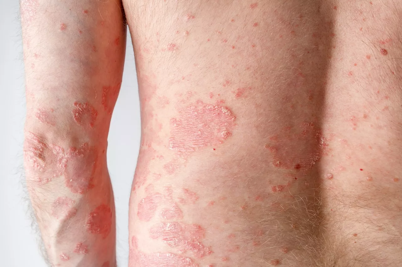 Ultra-processed foods increase active psoriasis risk, study shows