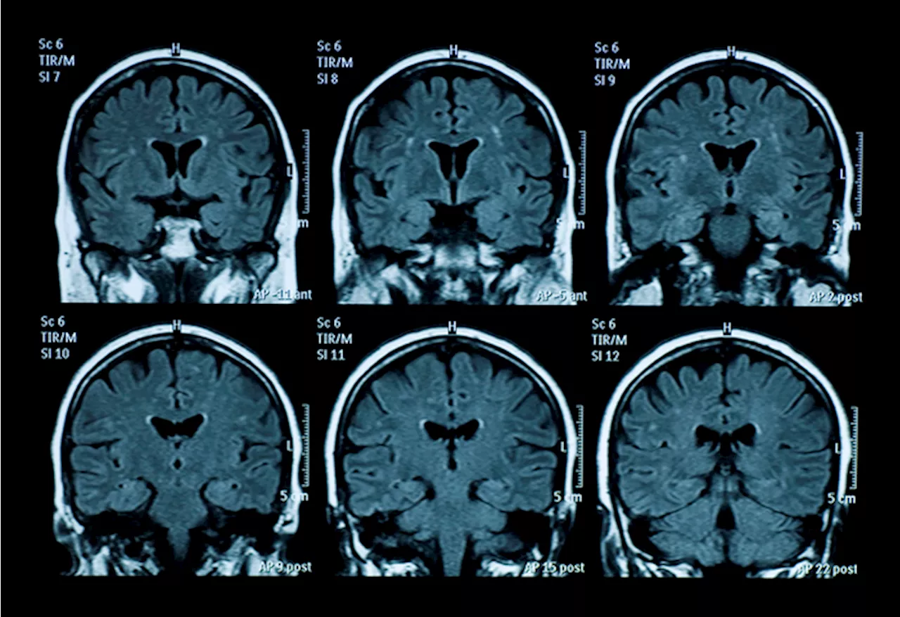 HCMV Potrebbe Essere Coinvolto nell'Alzheimer