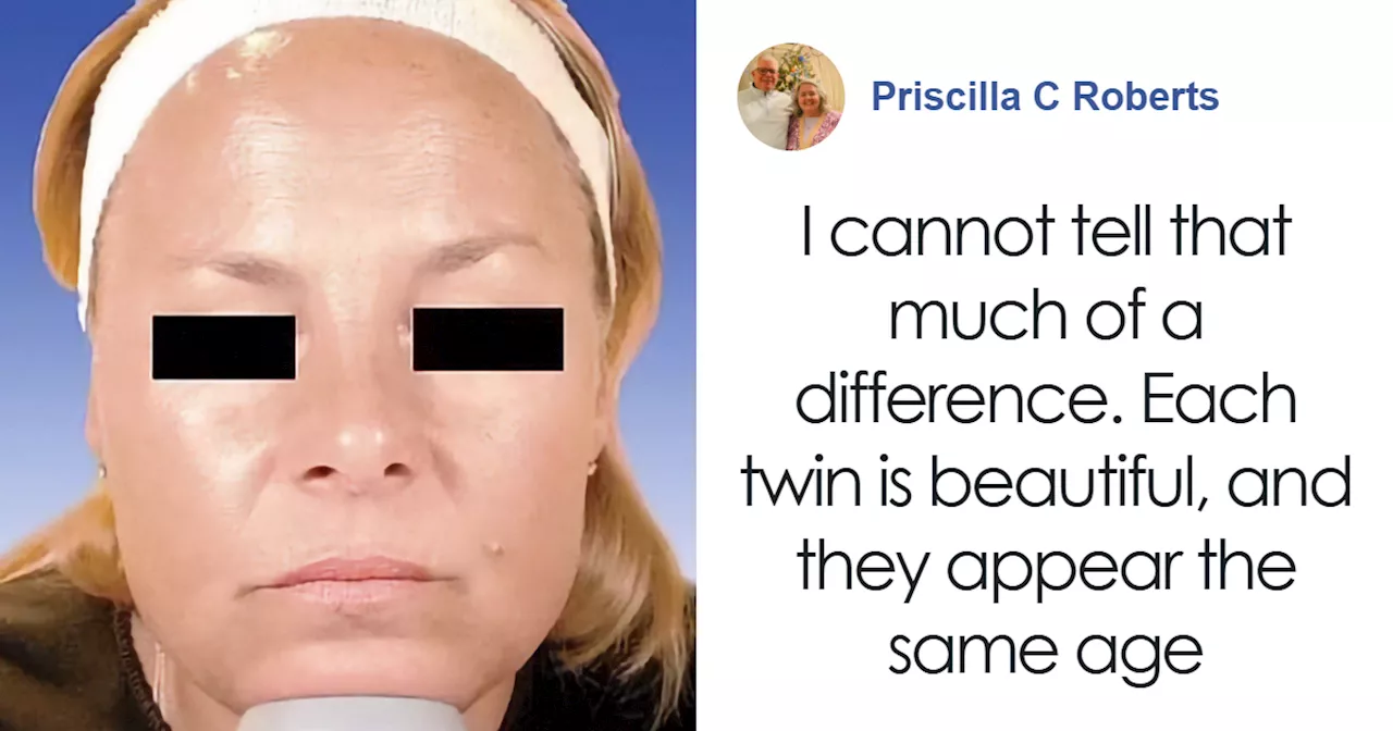 One Twin Ages Naturally, The Other Gets Botox, And Netizens Compare Both