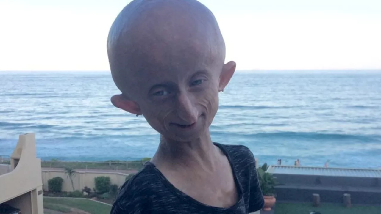 Muere Beandri Booysen, influencer sudafricana que superó las expectativas con Progeria