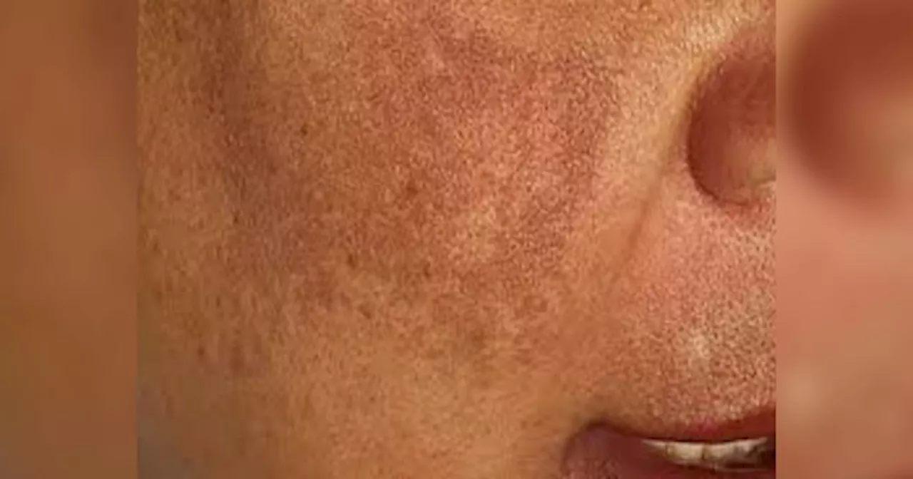 Wrinkles Remedy: नारियल तेल और हल्दी को मिलाकर करें ये काम, चेहरे की झाइयां हो जाएंगी दूर