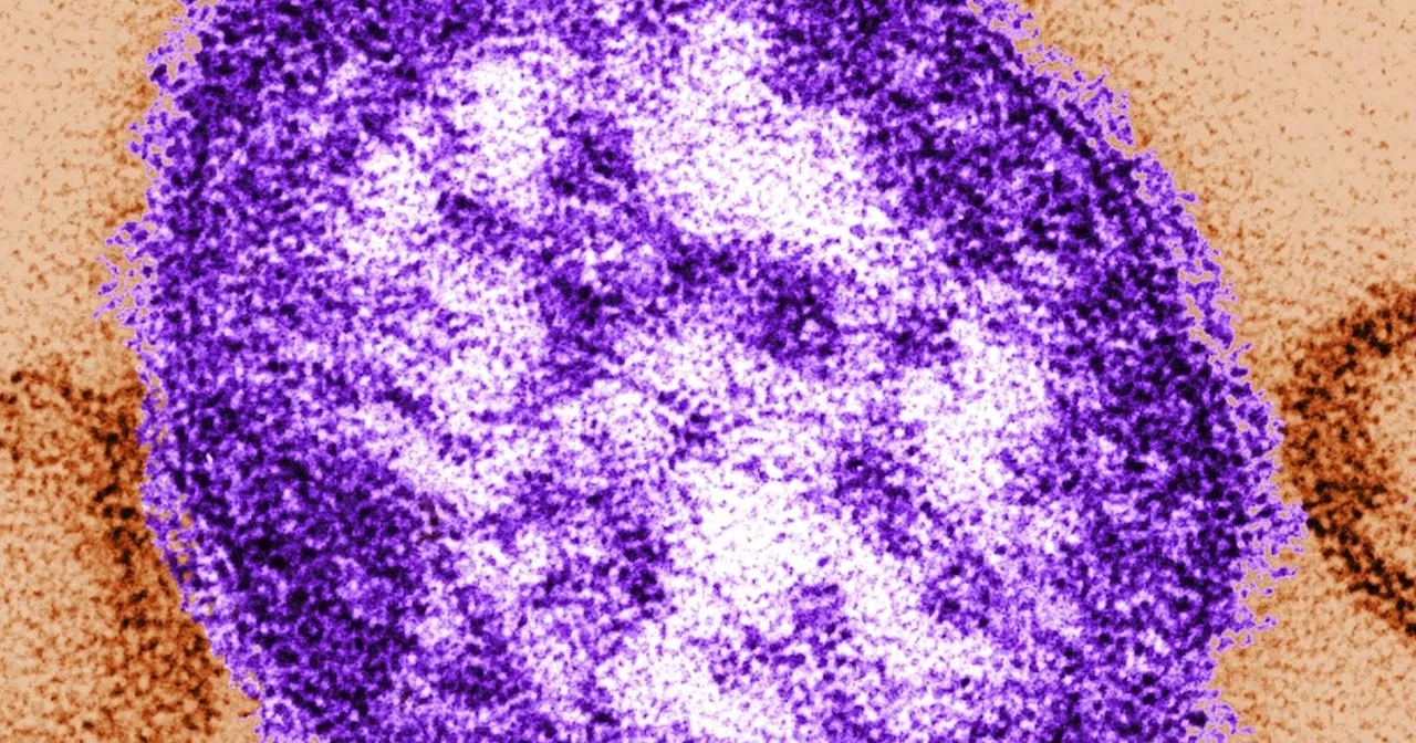 Ontario Measles Outbreak Linked to New Brunswick Grows to 37 Cases