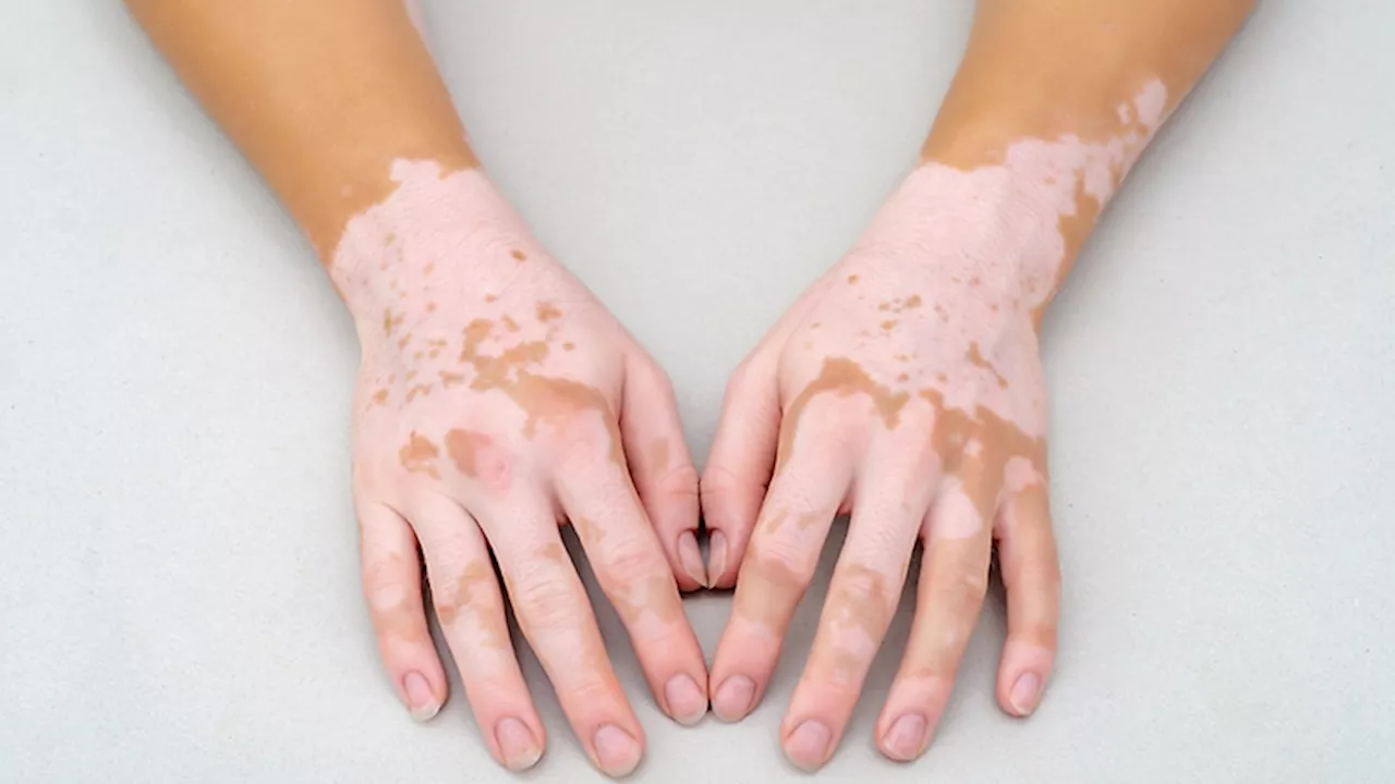 Vitiligo Treatment Advances: Patient-Centered Care and Novel Approaches