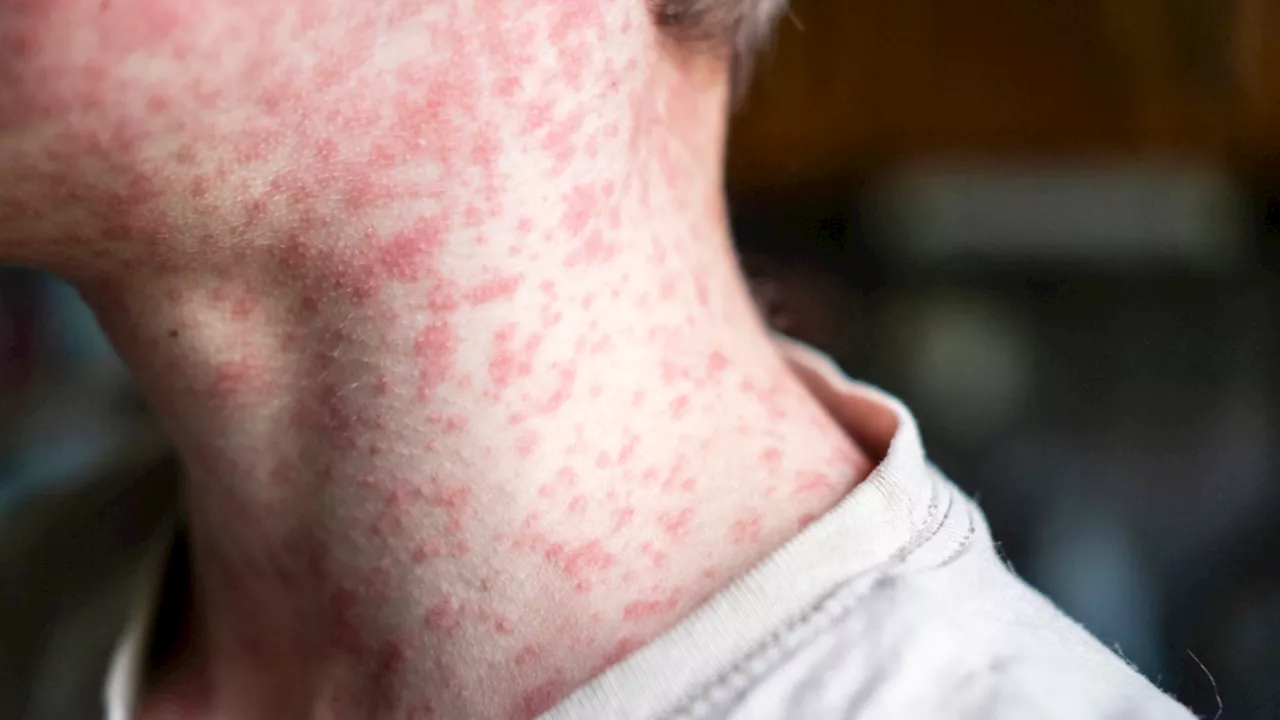 Measles Alert Issued in NSW After Confirmed Case Visits Multiple Locations