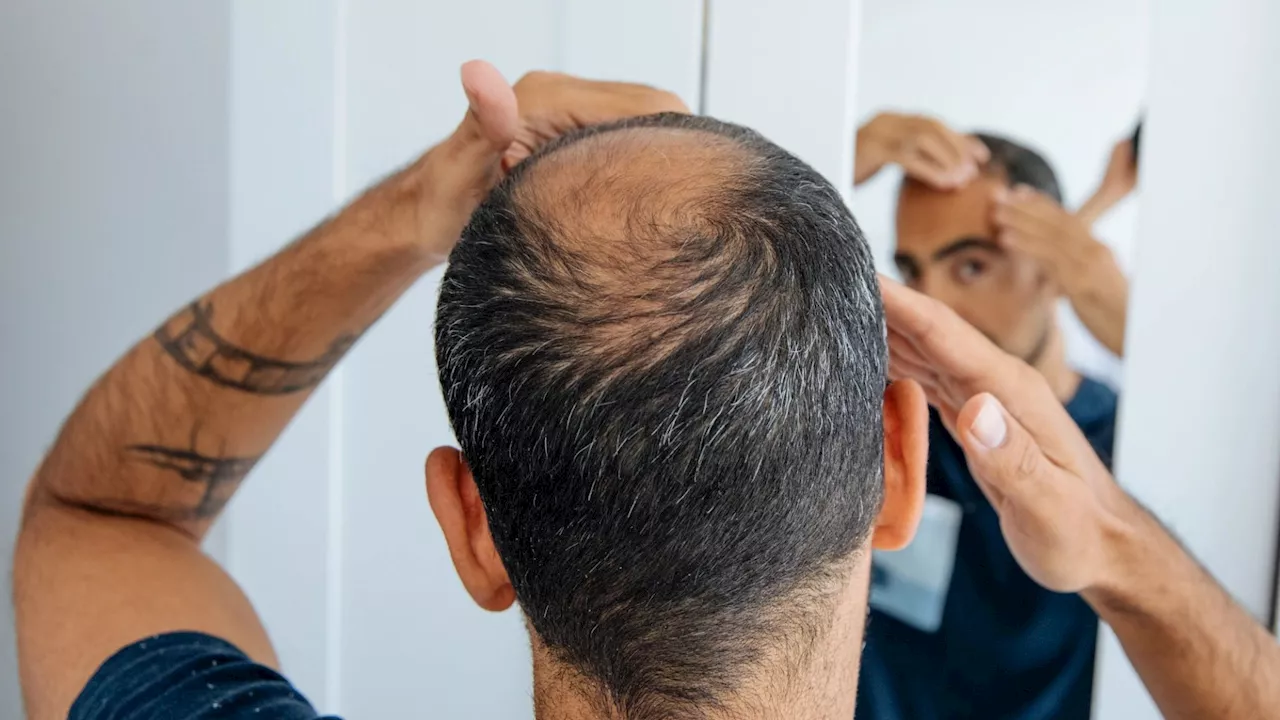 Ring Finger Length May Predict Baldness Risk