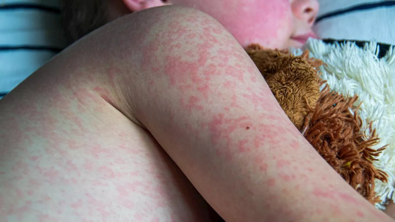 Measles Warning After International Flight Exposure