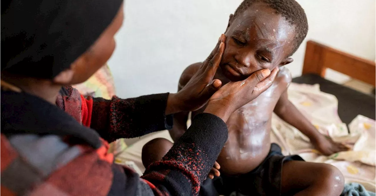 Mpox bis Cholera: 180 Epidemien auf afrikanischem Kontinent