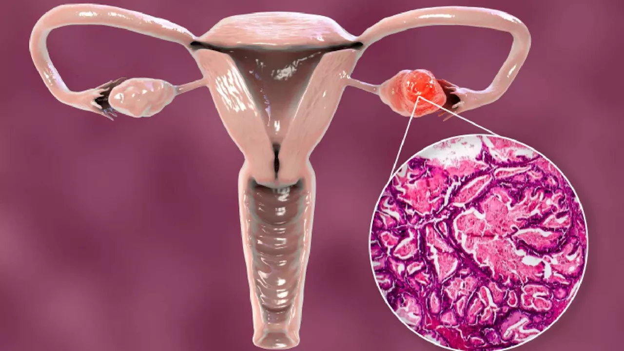 Ovarian Cancer Symptoms : क्या है ओवेरियन कैंसर ? जानिए इसके लक्षण और उपचार