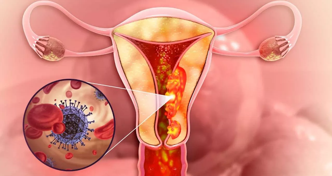 Desigualdades en la incidencia de cáncer cervical en Estados Unidos