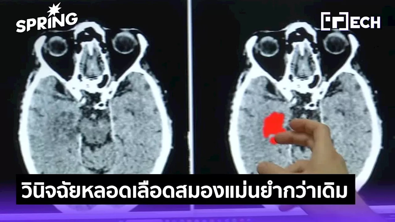 ซอฟต์แวร์ AI ช่วยอ่านสแกนสมองรักษา stroke แม่นยำ 2 เท่า