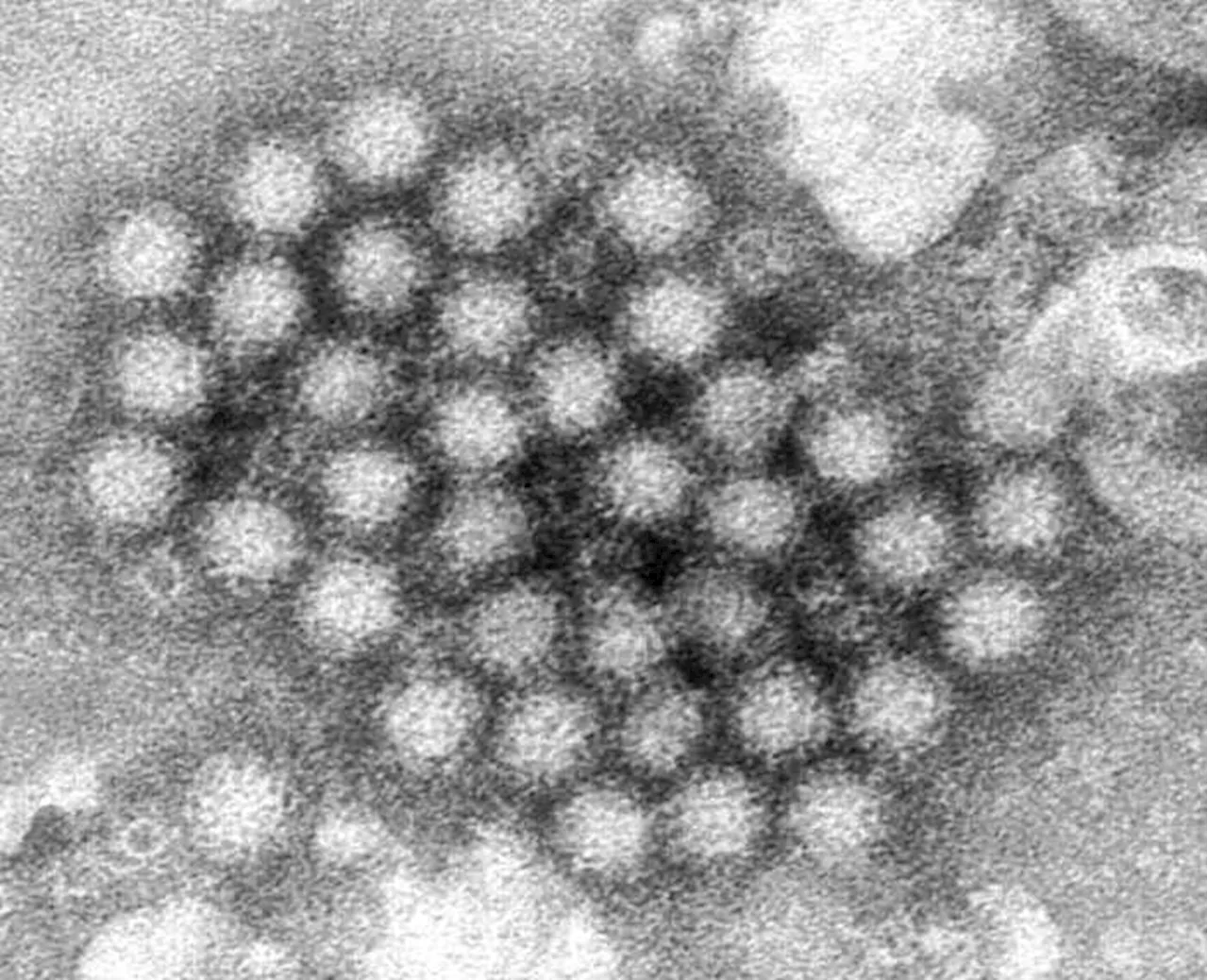 Nasty norovirus is back in full force with US cases of the stomach virus surging