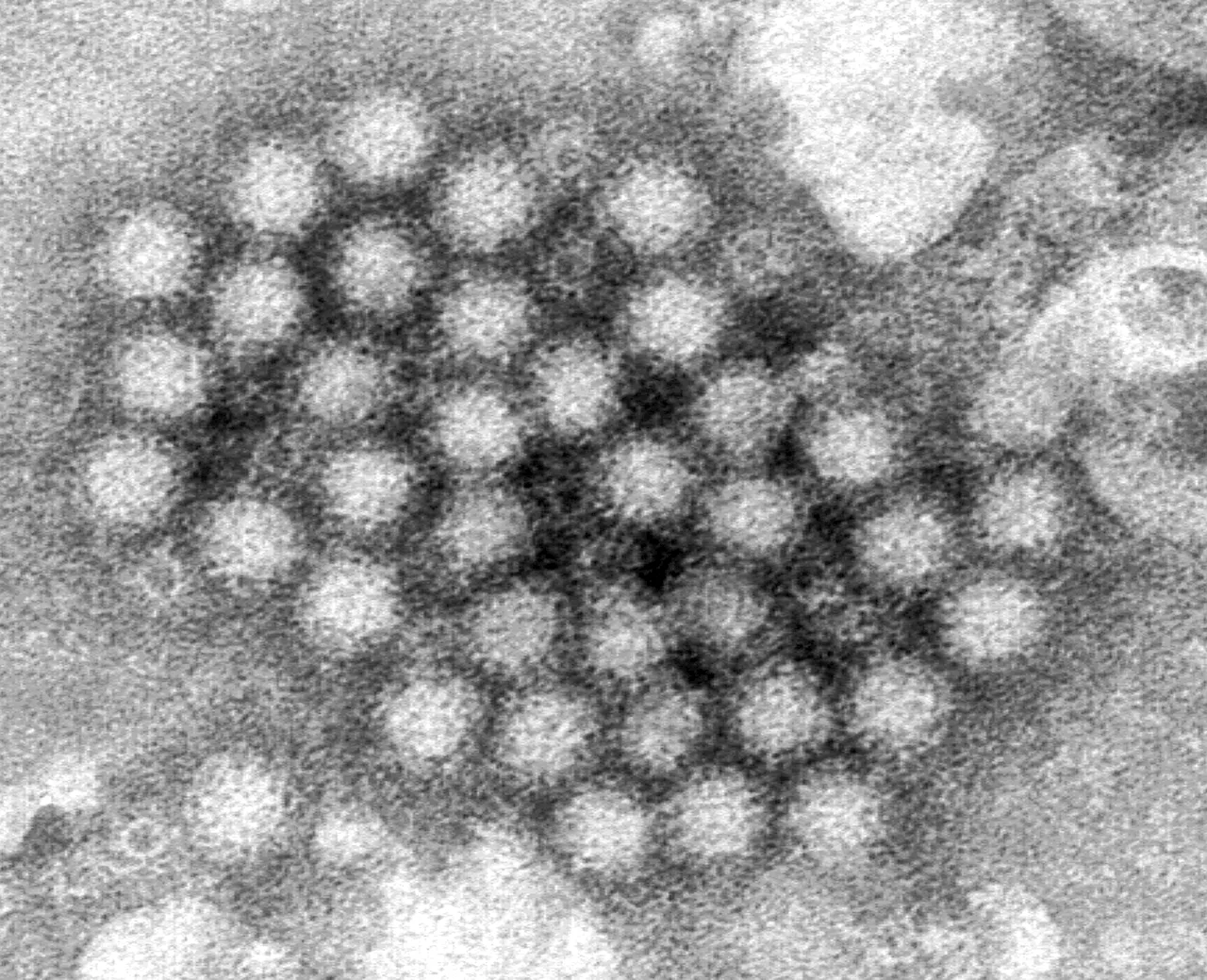 Norovirus Outbreaks Surge in the US