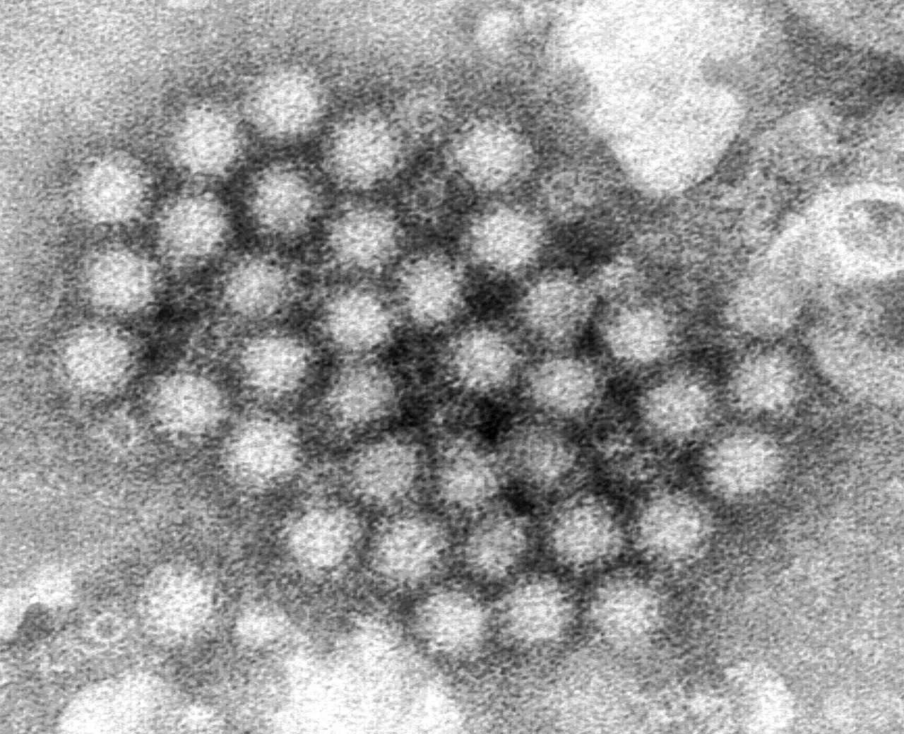 Norovirus Outbreak at Highest Level in Decades, Doctors Warn of Symptoms and Prevention