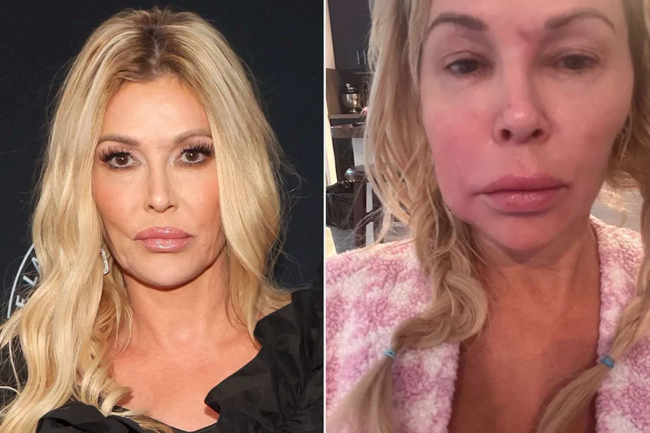 Brandi Glanville Says Her Face Issues Could Take 'Five Years' to Resolve