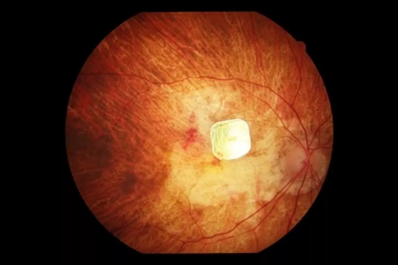 Retina artificiale migliora la vista di pazienti con grave malattia