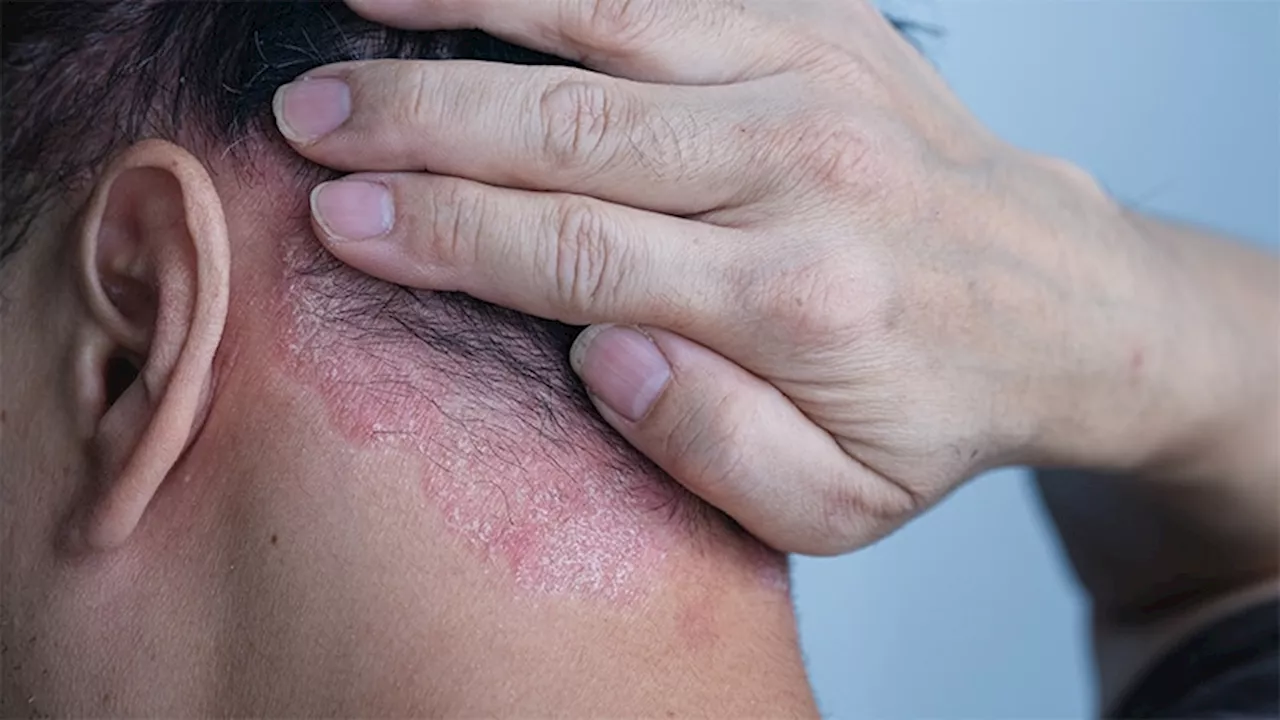 Tildrakizumab Shows Durable Response in Scalp Psoriasis