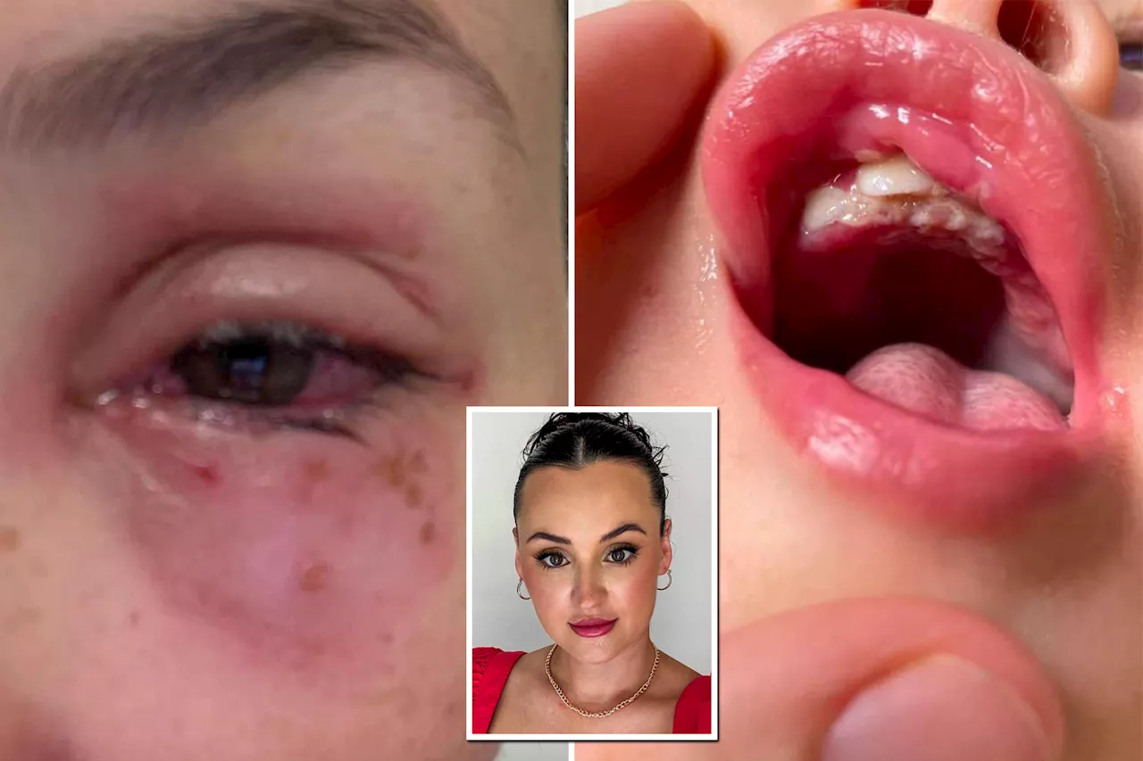 Mother Warns Parents After Daycare Cold Sore Leads to Eye Surgery