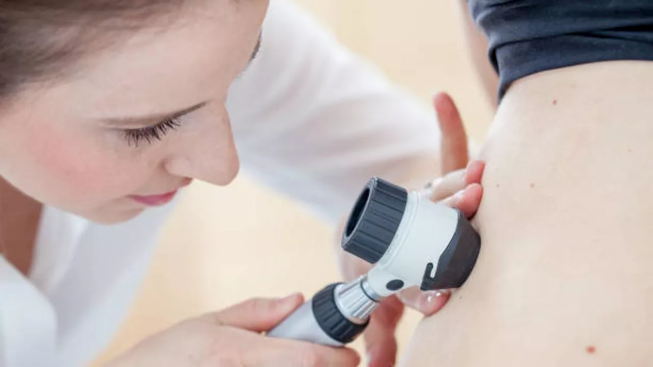 Melanoma, un nuovo farmaco sperimentale funziona per i pazienti che non hanno tratto vantaggio dall'immunoterapia