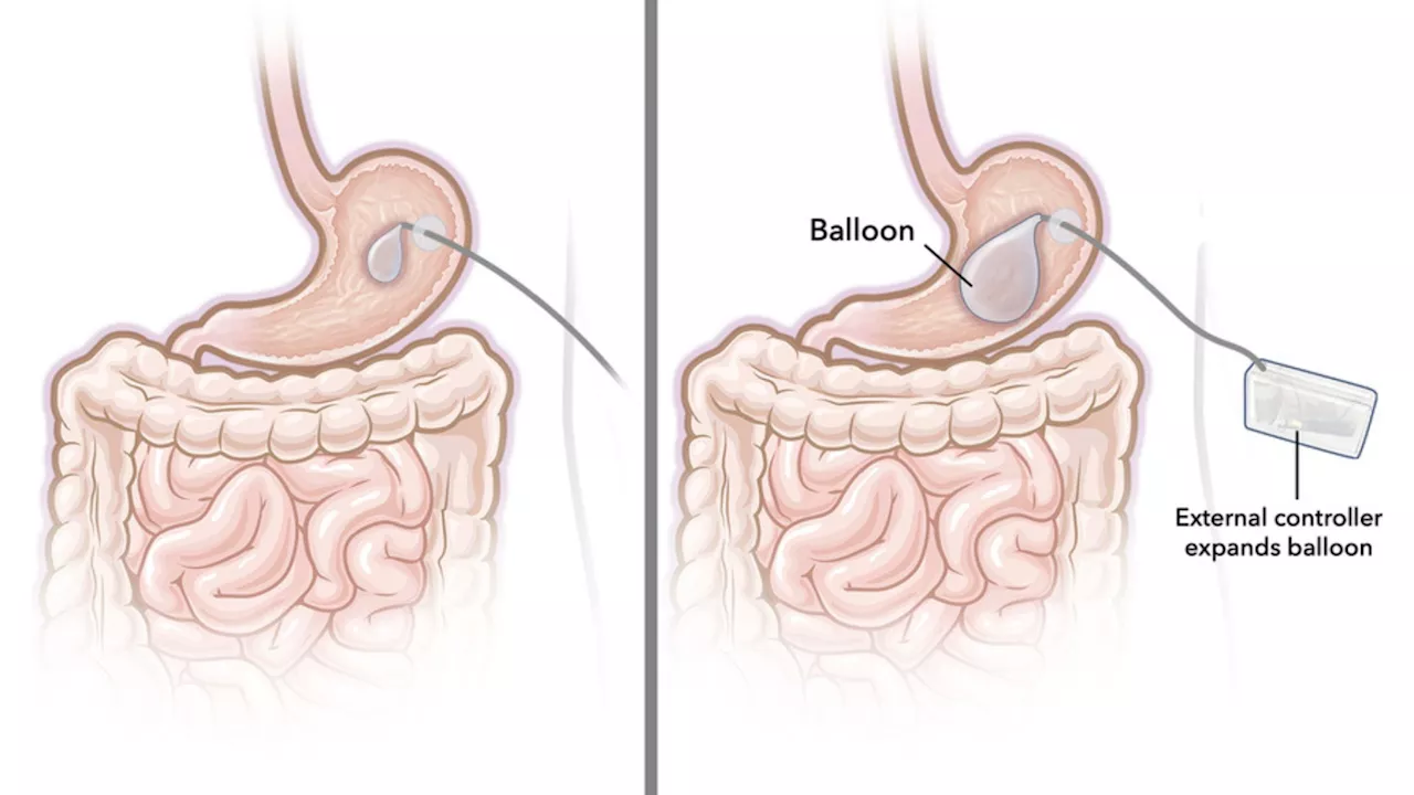 MIT’s new silicone balloons inflate, deflate in stomach to help people lose weight