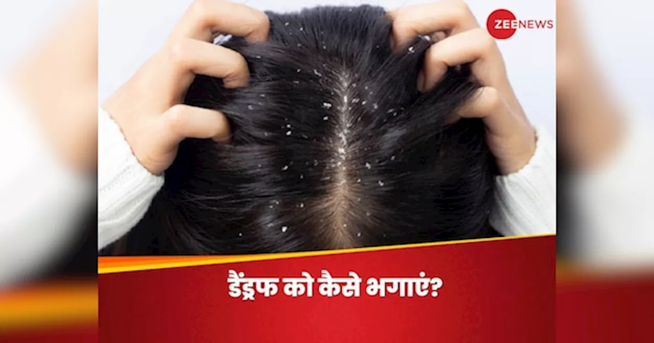 डैंड्रफ की वजह से होने लगी शर्मिंदगी? बालों के दुश्मन को इस तरह करें टाटा, बाय-बाय