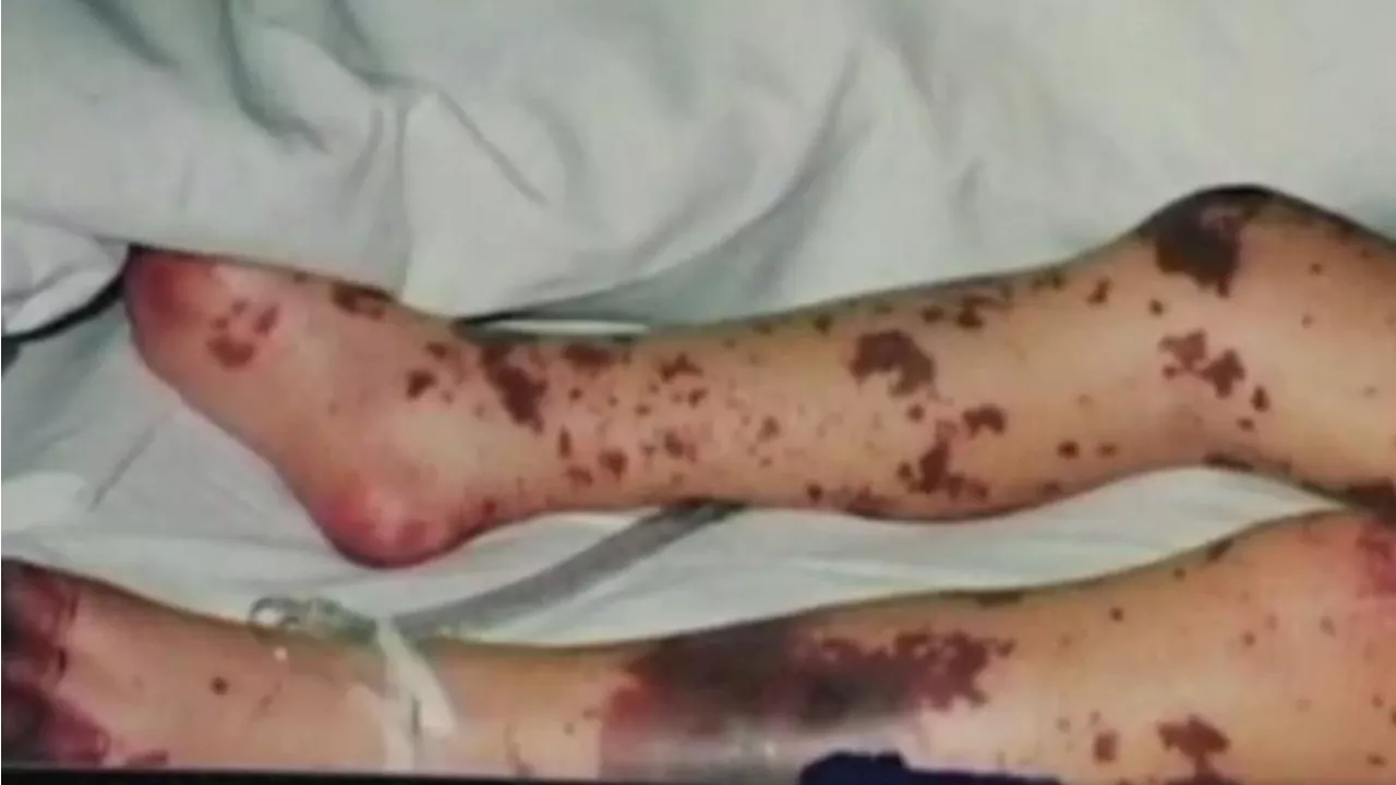 South Australian Teen Fighting for Life After Contracting Meningococcal Disease